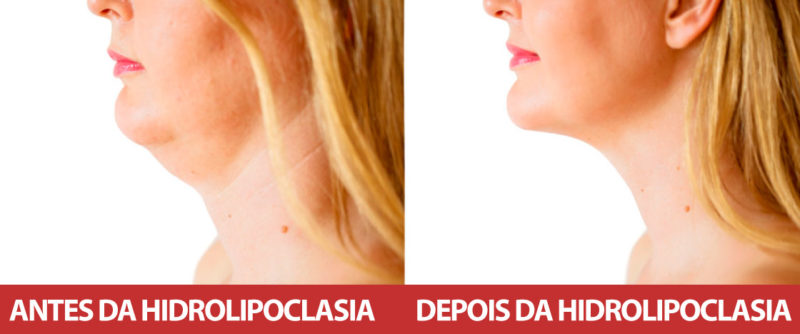 Como eliminar a papada no pescoço com a hidrolpoclasia